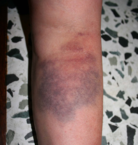 SFX bruised arm
