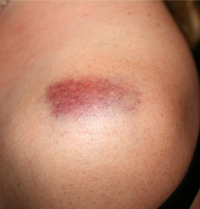 SFX bruised shoulder 