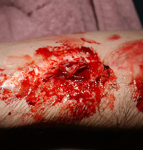 SFX severe cut