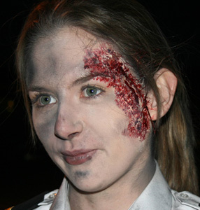 SFX facial injury