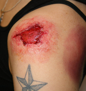 SFX wound